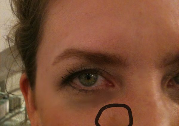 Image of a woman with a dark spot on her face circled