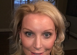 Photo of Cassis Microneedling results